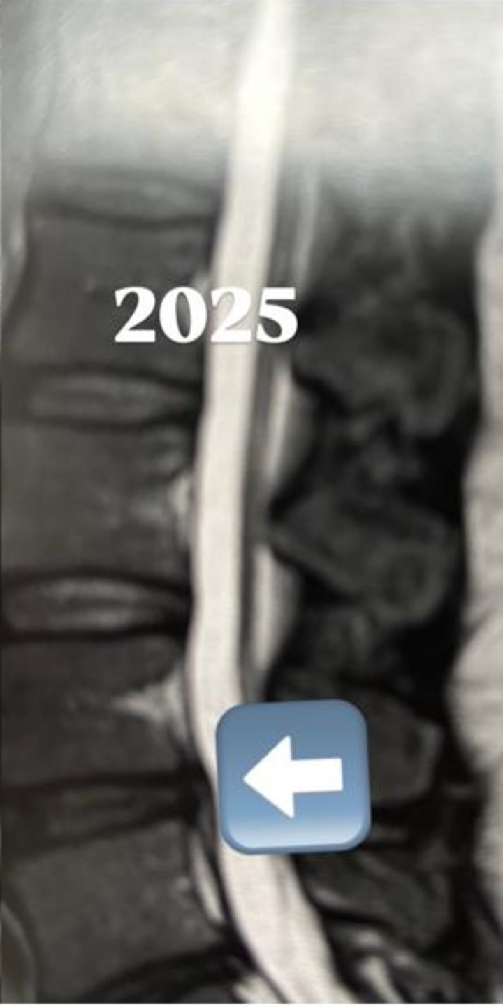 Ressonância magnética da coluna lombar em 2025, após um ano de acompanhamento.